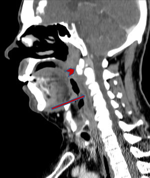 Corte sagital de TC de cuello con CIV, evidenciando colección prevertebral sin realce periférico asociado (flecha) y calcificación en el tendón del músculo longus colli a la altura de C2 (punta de flecha).