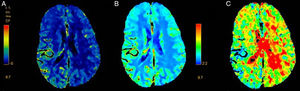 TC cerebral de perfusión correspondiente al paciente 6. Focalidad hemisférica derecha (NIHSS: 12). A) Aumento CBF hemisférico derecho. B) Aumento CBV hemisférico derecho. C) Acortamiento Tmáx en región cortical similar. No distribución en claro territorio vascular. No oclusión arterial en la angio-TC.