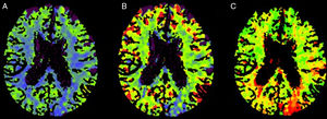 TC cerebral de perfusión correspondiente al paciente 9. Focalidad hemisférica izquierda (NIHSS: 10). A) Disminución CBF parietooccipital izquierdo. B) Disminución CBV parietooccipital izquierdo. C) Alargamiento Tmáx en región cortical similar. No distribución en claro territorio vascular. No oclusión arterial en la angio-TC.