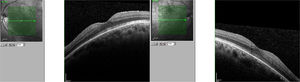 Resolución completa del edema macular, 20 días después de la retirada del tratamiento con fingolimod.