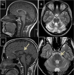A) RM-sagital T1: atrofia intensa del vermis cerebeloso en paciente con ARCA1; B) RM-axial-T2: atrofia pancerebelosa en el mismo paciente con ARCA1. C) RM-axial T1: atrofia de cuerpo calloso posterior en paciente con ARSACS; D) RM-axial T2: hiposeñales lineales protuberanciales en paciente con ARSACS.