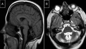 Síndrome de Marinesco-Sjögren. A) RM-sagital T1: atrofia de tronco y extensa atrofia vermiana. B) RM-axial T2: atrofia protuberancial, vermiana y de hemisferios cerebelosos, sin alteraciones de señal intraparenquimatosas.