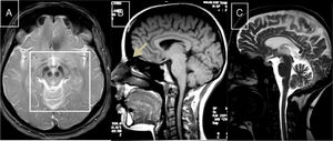 Heredoataxias metabólicas tratables: A) RM-axial T2: hiperintensidad periacueductal y de calota mesencefálica contrastando con la hipointensidad de cuerpos mamilares, núcleos rojos y sustancia negra perfilando «cara de oso panda» en paciente con EW. B) RM-sagital T1: senos craneales prominentes y atrofia medular en paciente con XC. C) RM-T2: atrofia cortical, de cuerpo calloso, tronco y vermis cerebeloso en paciente joven con enfermedad de NPC.