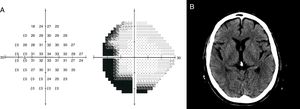 A) Campo visual de Humphrey, mostrando defecto campimétrico izquierdo del tipo temporal crecente. B) Tomografía cerebral sin alteraciones.