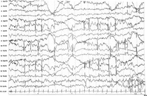 Registro video-EEG en el que destaca la presencia de actividad epileptiforme, habitualmente independiente sobre regiones centro-temporales de ambos lados, que se activa marcadamente durante el adormecimiento y sueño NREM, llegando a alcanzar una persistencia alta. Además, se aprecia actividad lenta irregular en regiones centro-temporales, entremezclada con la actividad epileptiforme mencionada. Sensibilidad: 15μV/mm, filtro de alta frecuencia: 70Hz y constante de tiempo: 0,3s.