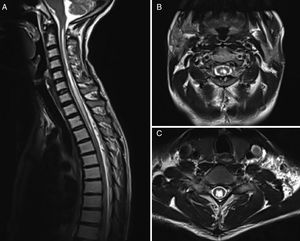 A) RM de ejemplo de siringomielia sin Chiari en secuencia T2 Sagital. B) Corte axial en secuencia T2 a nivel C2. C) Corte axial en secuencia T2 a nivel C6.