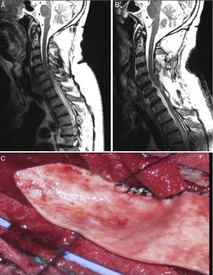 A) RM secuencia T2 sagital que muestra siringomielia D1-D5. B) RM sagital T2 posquirúrgica que muestra resolución del cuadro. C) Imagen quirúrgica de duraplastia en proceso.