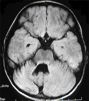 RM cerebral del caso 1, secuencia FLAIR corte axial. RM realizada después de 15 meses de la hemicerebelitis, mostrando la hemiatrofia del hemisferio cerebeloso derecho.