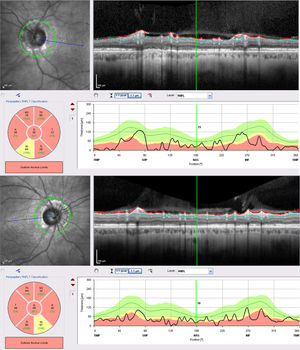 Tomografía de coherencia óptica en la que se observa atrofia grave en la capa de fibras nerviosas peripapilar de ambos nervios ópticos.