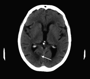 TC craneal simple, la flecha señala una lesión hipodensa occipital, compatible con ictus isquémico en estadio subagudo/crónico.
