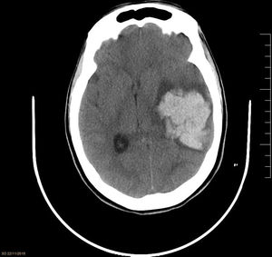 Imagen de la TC. Hematoma intraparenquimatoso temporoparietal izquierdo (51×50×38mm) con efecto masa y desviación de estructuras intracraneales presentado por la paciente del caso.