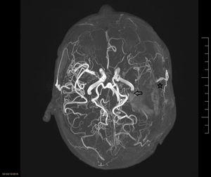 Imagen de la RM (reconstrucción TOF). Reconstrucción de sistema arterial intracraneal de la paciente presentada. Se objetiva obstrucción completa de la ACM izquierda (flecha) e imágenes típicas de circulación colateral típica de EMM (estrella).
