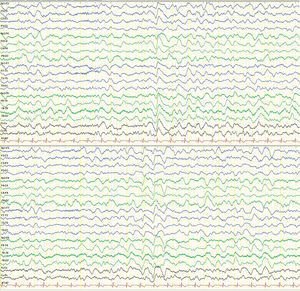 Registro electroencefalográfico (EEG) día 2 (segundo episodio): montaje longitudinal a 7μV/mm. Actividad de fondo globalmente lentificada de grado importante, actividad delta rítmica, con morfología bi-trifásica ocasional que sugiere la presencia de una encefalopatía difusa.