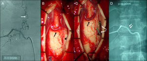 Arteriografía espinal y fotos intraoperatorias de una fístula arteriovenosa espinal dural dependiente de la arteria radicular derecha en D11. A: la arteriografía selectiva muestra una conexión fistulosa bajo el pedículo derecho del cuerpo vertebral de D11 (asterisco) entre la rama radiculomeníngea y la vena varicosa perimedular superior (flecha blanca). B: foto intraoperatoria tras haber realizado laminectomía D11 y durotomía, que muestra venas perimedulares tortuosas arterializadas (flecha negra) en íntima relación con la raíz nerviosa (cabeza de flecha negra). C: tras colocación de clips (flechas blancas), coagulación y sección de la vena de drenaje a nivel de la raíz, se objetiva el colapso inmediato y el oscurecimiento de las venas perimedulares (flecha negra). D: la arteriografía posquirúrgica demuestra la oclusión completa de la fístula. Las flechas señalan los 2 clips vasculares.