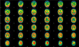 SPECT de perfusión cerebral inicial realizada tras la administración de 925MBq de 99mTc-HMPAO. Se muestran cortes tomográficos representativos en proyección transaxial. Mediante valoración cualitativa se objetiva una función cortical irregular en ambos hemisferios, con áreas de hipoactividad más intensas en la región frontal anterior y orbitaria, así como mesial temporal del hemisferio derecho. En el lado izquierdo se observan defectos en la región frontoorbitaria, así como temporobasilar y mesial. En núcleos basales es evidente una asimetría estando disminuida la actividad en el lado derecho, sin que sean evidentes alteraciones en cerebelo.