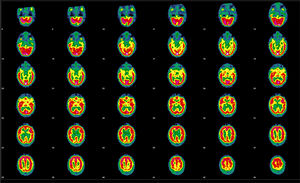 SPECT de perfusión cerebral evolutivo realizada tras la administración de 925MBq de 99mTc-HMPAO, a los 20 meses del estudio previo. Se muestran cortes tomográficos representativos en proyección transaxial. Se evidencia una función cortical irregular en ambos hemisferios, con defectos que alcanzan mayor intensidad en las regiones fronto-orbitarias y temporales, presentando el resto de ambos hemisferios pequeñas irregularidades que se distribuyen difusamente, sin que a nivel de núcleos basales y cerebelo se observen alteraciones. Comparativamente con el estudio previo se evidencia una mejoría defectos descritos en las regiones fronto-orbitarias y temporales, y normalización de la captación en la región frontal anterior.