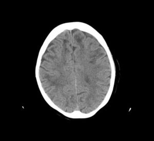 Tomografía computarizada cerebral que muestra lesiones hipodensas en sustancia blanca subcortical en ambos lóbulos frontales.