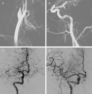 Arteriografía cerebral. Cateterización de la arteria carótida común derecha con oclusión proximal de la arteria carótida interna (a) y de la arteria cerebral medial proximal (b). Arteriografía de control después del primer paso de stent retriever (c) y del segundo (d).