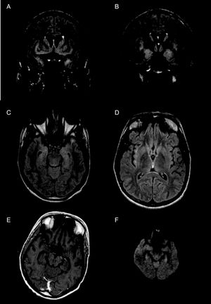 Resonancia magnética (RM) cerebral realizada al diagnóstico. Se observa un aumento de señal de la corteza en secuencias T2 FLAIR coronal (A-B) y T2 axial (C-D) afectando a ambos hipocampos, amígdalas, polos temporales, así como de las regiones basal y parasagital de ambos lóbulos frontales, ambas ínsulas, globos pálidos y núcleos caudados. Tras la administración de contraste por vía intravenosa (E) no se observan realces patológicos. Las lesiones no producen efecto de masa ni muestran restricción de la difusión en secuencias DWI (F).