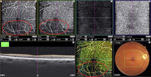 Imagen OCTA del ojo derecho donde se objetiva pérdida de la red vascular superficial y profunda de la retina en región temporal inferior (áreas de isquemia rodeadas por óvalo).