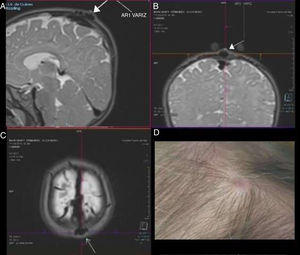 A) Resonancia magnética corte sagital secuencia T2W. Se visualiza variz (flecha blanca, imagen de vacío de señal) con drenaje en seno sagital. B) Corte coronal a nivel de la variz (flecha blanca). Se observa la protrusión en superficie. C) Imagen axial en la que se observa el nivel de la lesión y su localización en línea media. D) Aspecto externo del sinus pericranii. Mácula a nivel de cuero cabelludo, fluctuante en la exploración.