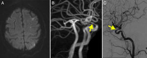 A. RM secuencia difusión que muestra infartos en territorio frontera silviana izquierda. B. Angio-RM en la que se aprecian estenosis en segmentos carotídeos supraclinoideos (flecha). C. Angiografía cerebral que confirma la estenosis en el segmento carótido-oftálmico (flecha).
