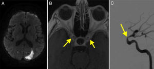 A. RM secuencia difusión que muestra infarto en la región occipital izquierda. B. RM T1 con contraste que muestra realce de paredes de carótidas internas (flechas). C. Angiografía cerebral que confirma la estenosis en el segmento carótido-oftálmico (flecha).