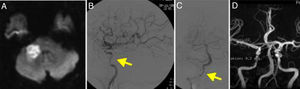 A. RM secuencia difusión que muestra infarto en el territorio del pedúnculo cerebeloso derecho. B. Angiografía cerebral de la carótida izquierda que muestra múltiples estenosis en la arteria carótida interna (flecha). C. Angiografía de la arteria vertebral derecha que muestra estenosis de los segmentos extracraneales (flecha). D. Angio-RM realizada 2 años después en la que se observa la recuperación de las estenosis.