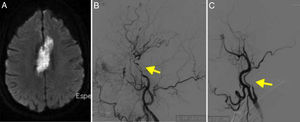 A. RM secuencia difusión que muestra un infarto en el territorio de ambas arterias cerebrales anteriores. B. Angiografía cerebral de la carótida izquierda que muestra múltiples estenosis en la arteria carótida interna (flecha). C. Angiografía que muestra la oclusión de la carótida interna derecha, simulando una disección (flecha).