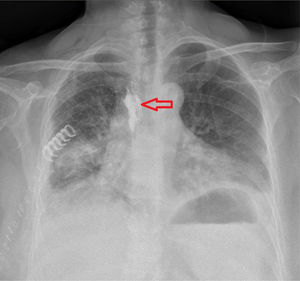 Radiografía postero-anterior de tórax: difusión paravertebral a nivel del 3.° al 5.° espacio intercostal de contraste yodado instilado a través del catéter (flecha).