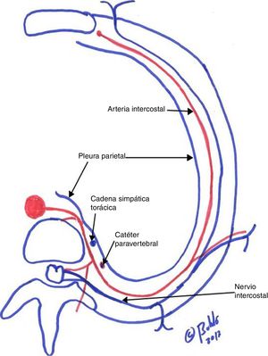 Localización del catéter paravertebral y su relación anatómica con la cadena simpática y el nervio intercostal.