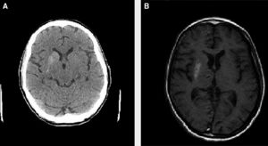 A) TC cerebral que muestra hiperdensidad a nivel ganglios basales derechos. B) RM cerebral en secuencia T1 que muestra una hiperintensidad de ganglios basales derechos.