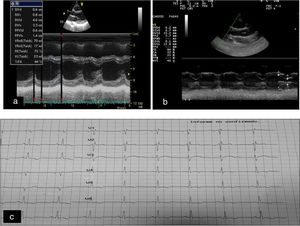a) Ecocardiografía basal. b) Ecocardiografía un año después del tratamiento con rhIGF-1: discreta reducción del septum interventricular y del diámetro diastólico del ventrículo izquierdo (DdVI). c) Cambios en la repolarización manifestados por cambios en las ondas T sin ondas q patológicas.
