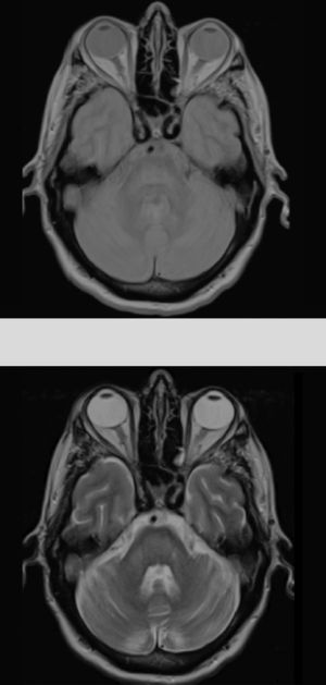 RMN craneal control a los 5 meses, con resolución de la clínica. Alteración en la intensidad señal (secuencias DP-T2, FLAIR) protuberancial como secuela de mielinólisis central pontina.