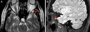 RM cerebral, imagen axial potenciada en T2 (A) e imagen sagital T2 FLAIR (B): se objetiva una pequeña herniación de parénquima cerebral en el polo anterior de lóbulo temporal izquierdo a través de un defecto óseo anterior de la base del cráneo, sugestiva de encefalocele.