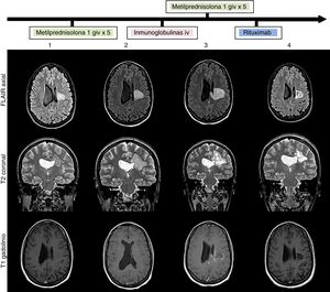 RM cerebral: evolución de la lesión (secuencias FLAIR, T2 y T1 gadolinio) al ingreso (1), tras tratamiento con un pulso de metilprednisolona intravenosa (2), tras tratamiento con inmunoglobulinas intravenosas (3) y tras tratamiento con rituximab (4). Lesión heterogénea con seudohalos agrupados-confluentes (1 y 2) que evolucionan a áreas quístico-malácicas (3 y 4), afectando a corona radiada y centro semioval izquierdos con extensión al cuerpo calloso. Tamaño de 3cm en su diámetro máximo al ingreso (1) que aumenta hasta 4,1cm a pesar del tratamiento (3) y posterior reducción a 3cm tras rituximab (4). No edema perilesional ni efecto masa. Ausencia de realce tras la administración de contraste al ingreso (1) con posterior realce parcheado intra y perilesional a pesar de corticoesteroides e inmunoglobulinas (3) que desaparece tras tratamiento con rituximab (3).