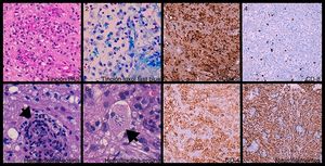 Biopsia cerebral: histiocitos espumosos (1, 2 y 3) ([3] CD68+), cargados de mielina fagocitada ([1] material PAS positivo y [2] Luxol Fast Blue positivo) y linfocitos T (4 y 7) ([4] CD8+ y [7] CD4+), entremezclados con astrocitos y células de Creutzfeldt —astrocitos reactivos— (6, flecha). Manguitos perivasculares (5, flecha). Preservación de la trama axonal (8).