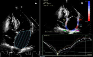 Ecocardiografía transtorácica bidimensional en proyección apical de 4 cámaras de nuestra paciente. Medición del volumen de la aurícula izquierda mediante método de Simpson biplano (A) y del strain longitudinal de la aurícula izquierda mediante técnicas de speckle tracking (B).