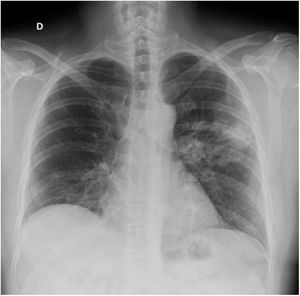 Radiografía de tórax que muestra una opacidad pulmonar basal derecha y consolidación alveolar en campo medio izquierdo.