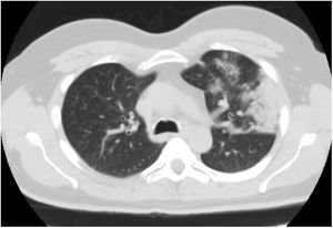 TAC de tórax que muestra infiltrado parenquimatoso en vidrio deslustrado en lóbulo pulmonar superior izquierdo.