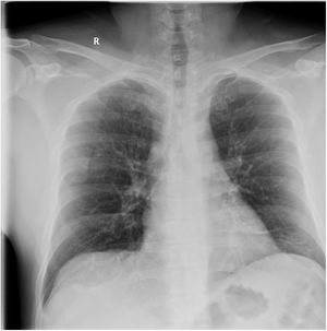 Radiografía PA de tórax en la que se observa un tenue aumento de densidad en vidrio deslustrado en campo medio derecho, que en el contexto epidemiológico actual es sugestivo de neumonía incipiente por SARS-CoV-2.