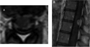 A) RM con realce meníngeo espinal a nivel dorsal en corte axial tras gadolinio. B) Lesión captante de contraste extraaxial posterior a nivel D10 sugerente de absceso en secuencia T1 sagital con gadolinio.