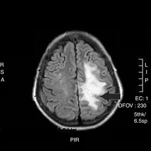 RMN cerebral realizada a las 48h: zonas con restricción de difusión sugestivas de lesión isquémica en territorio de arteria cerebral media y arteria cerebral media izquierdas (flecha).