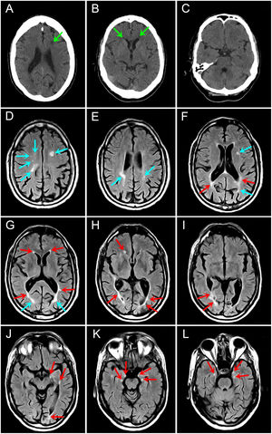 Pruebas de neuroimagen efectuadas al inicio y durante el seguimiento del paciente. A-C) TAC craneal en la presentación clínica (sin contraste): se revela la presencia de lesiones hipodensas subcorticales inespecíficas, mal delimitadas, en la región periventricular de ambos hemisferios cerebrales y en la parte anterior del lóbulo frontal izquierdo (flechas verdes), probablemente relacionadas con placas de desmielinización (paciente previamente diagnosticado de EM). Estudio sin hallazgos de patología intracraneal aguda. Desafortunadamente, el procedimiento radiológico se interrumpió, ya que no fue posible obtener una neuroimagen empleando el material de contraste iodado a causa de la agitación psicomotriz del paciente en el contexto de una probable reacción alérgica al medio iodado. D-L) RM craneal realizada 3 meses después (secuencia FLAIR en el plano axial): las imágenes muestran al menos 30 lesiones hiperintensas supratentoriales (flechas rojas y azules brillantes). Algunas lesiones tienen una morfología ovoide y otras son confluentes de bordes irregulares y poco definidos, siendo compatibles con placas de EM de bordes puntiagudos. La gran mayoría de las lesiones se agrupan alrededor de las regiones periventriculares (flechas rojas), especialmente en la sustancia blanca profunda que rodea las astas temporales de los ventrículos laterales (J-L). Ulteriormente, no se obtuvo un realce después de la administración de contraste en las secuencias potenciadas en T1. Sin hallarse lesiones en otras regiones, incluidos todos los segmentos de la médula espinal. EM: esclerosis múltiple; FLAIR: fluid-attenuated inversion recovery; RM: resonancia magnética; TAC: tomografía axial computarizada.