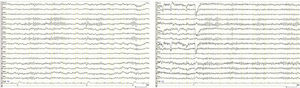 Imágenes de EEG pre y postinsulinoterapia. Se observa una asimetría en la actividad alfa en el primer registro, ausente en el segundo.