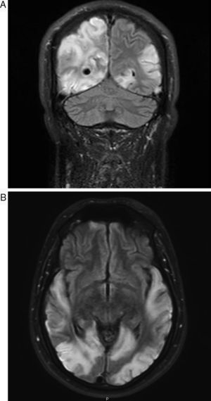 A) Coronal). B) Axial. Lesiones hiperintensas en secuencia de resonancia FLAIR afectando al cortex temporo-parieto-occipital bilateral, que no se corresponden con territorios vasculares.