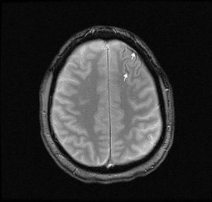 RM cerebral en secuencia T2 que muestra depósitos de hemosiderina (flechas) en los surcos de la convexidad frontal izquierda, correspondientes con HSAc.