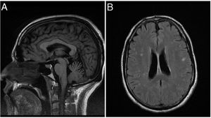 Resonancia magnética craneal: A) Atrofia vermis cerebeloso superior en T1. B) Imágenes hiperintensas en T2 FLAIR.