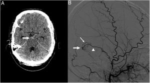 A) La TC craneal muestra un acúmulo focal de HSA que ocupa la cisterna interpeduncular (flecha). B) La ASD de vasos cerebrales que muestra la FAVD del seno transverso derecho (flecha), con aporte proveniente desde una rama temporal de la arteria meníngea media homolateral (cabeza de flecha), con reflujo retrogrado hacia una vena cortical (flecha fina).