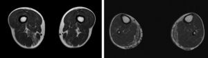 RMN de muslos y piernas con cortes axiales en T1 en los que se observa infiltración grasa asimétrica de los músculos semimembranoso y gemelo medial.